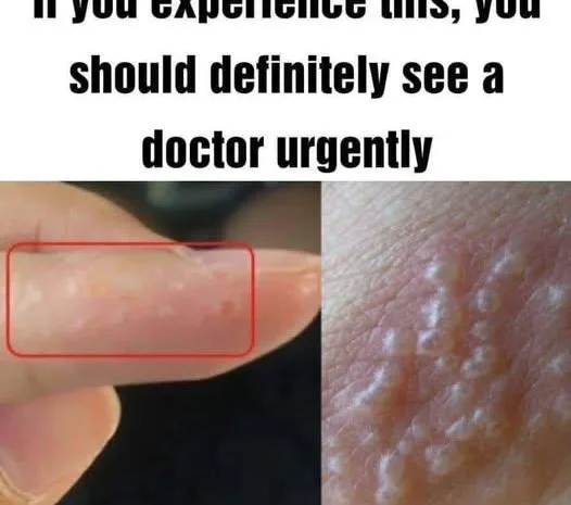 If You Notice Painful Red Bumps, You Might Have Dyshidrotic Eczema