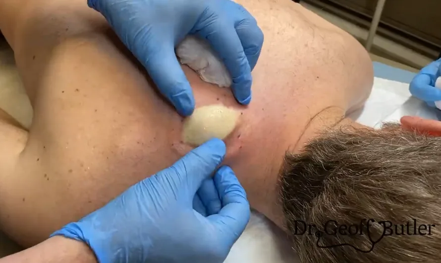 TREATMENT OF Cyst Plot Twist COMMITTED TO NOT RECURRING, NOT LEAVING SCARS