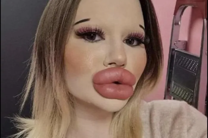 24-year-old woman wants the biggest lips in the world