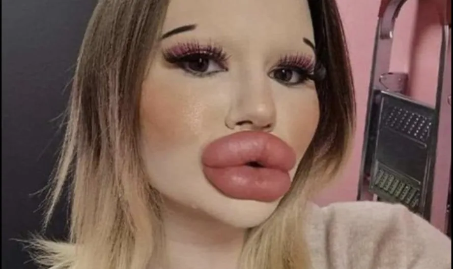 24-year-old woman wants the biggest lips in the world